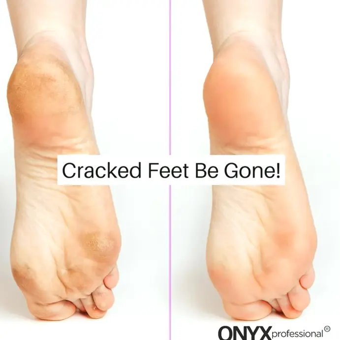 Moisturizing Gel Socks, Dry Feet Care